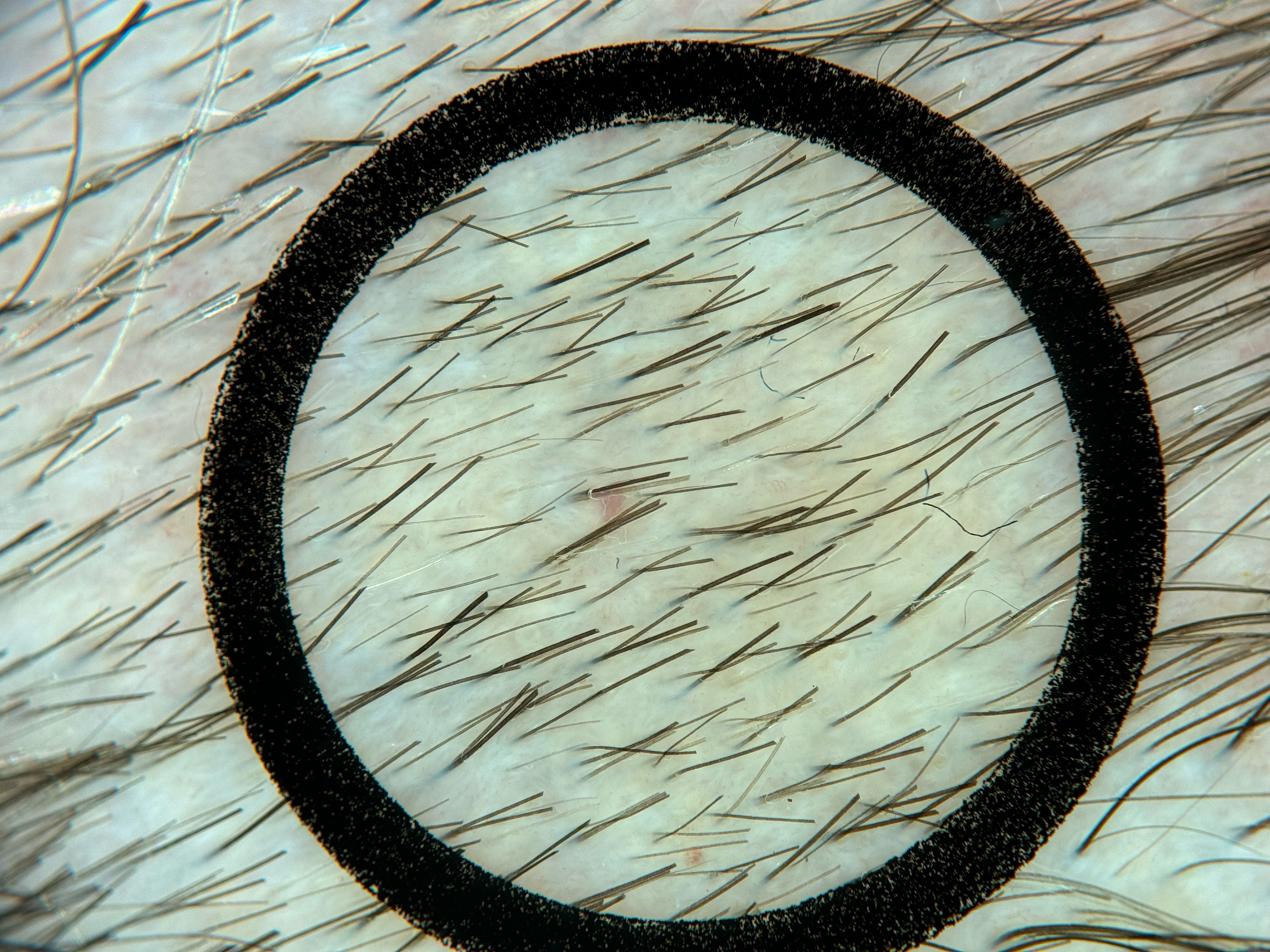 Beispielbild 1 für die TrichoScan-Analyse, aufgenommen mit Heine Delta 30