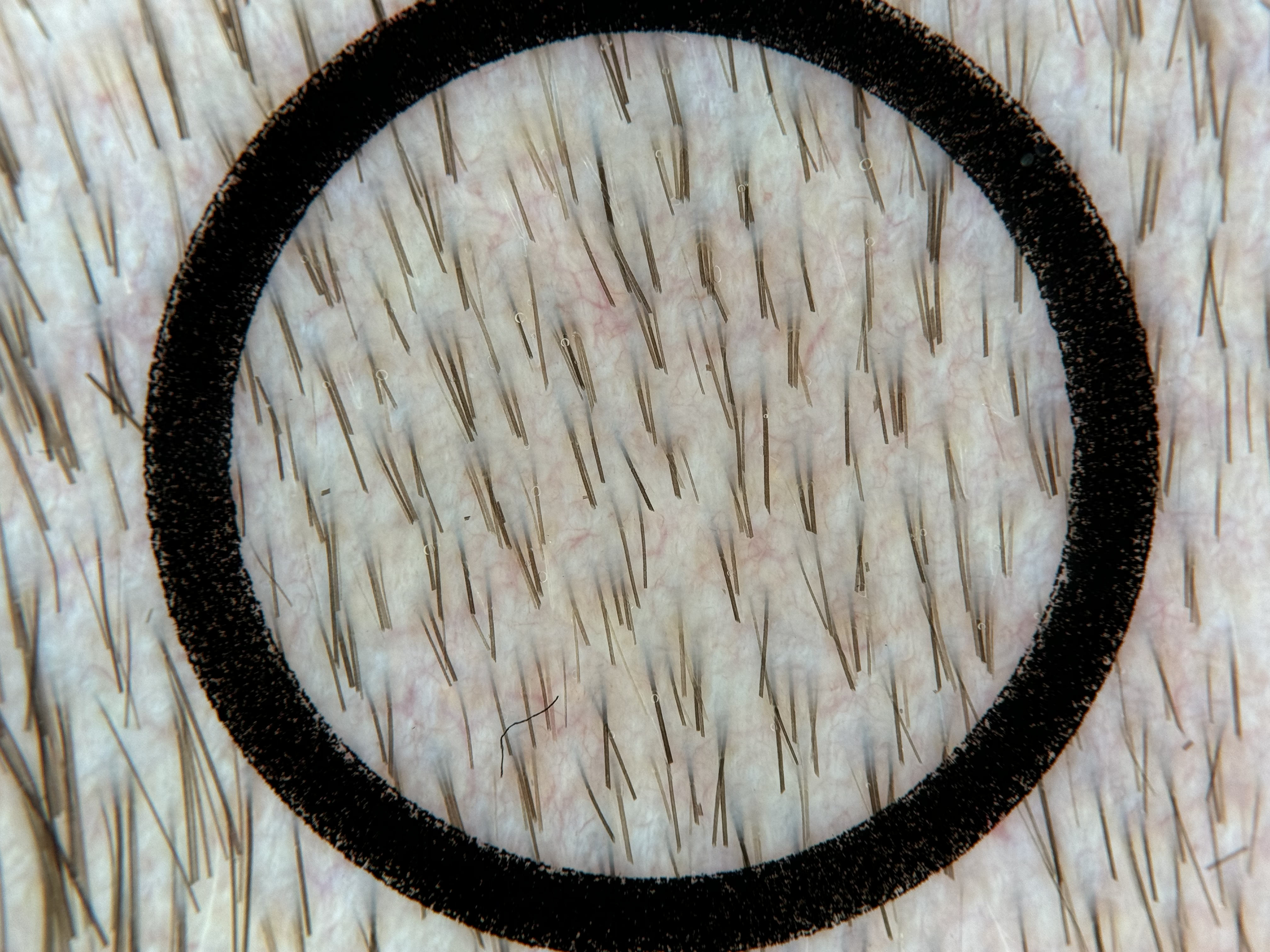 Beispielbild 2 für die TrichoScan-Analyse, aufgenommen mit Heine Delta 30