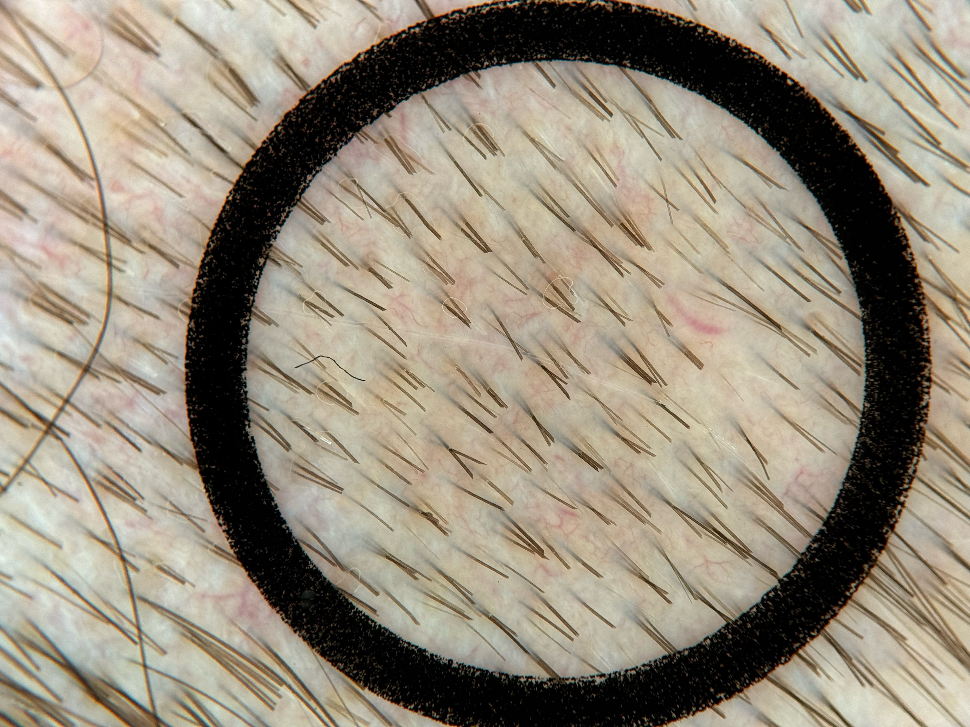 Beispielbild 3 für die TrichoScan-Analyse, aufgenommen mit Heine Delta 30