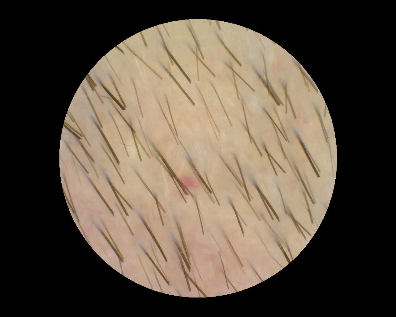 Beispielbild 4 für die TrichoScan-Analyse, aufgenommen mit Dino-Lite