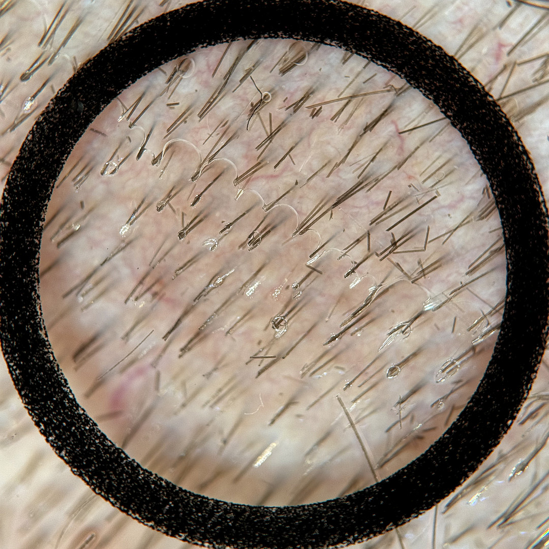 Ungeeignetes Beispielbild: Dermatoskop schräg aufgesetzt und störende Haarreste